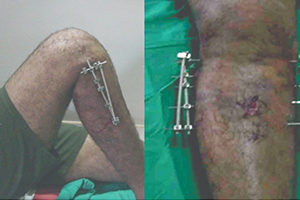 knee pain treatment in coimbatore-vgmorthocentre.com.jpg  