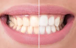Philips-Zoom.jpg  