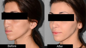 blepharoplasty-and-otoplasty.jpg  
